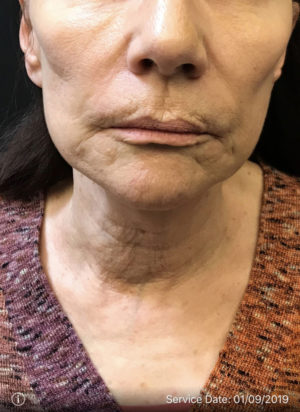 Facetite