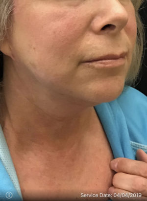Facetite