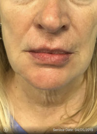 Lip Augmentation