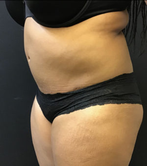 Liposuction