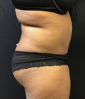 Liposuction