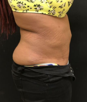 Liposuction