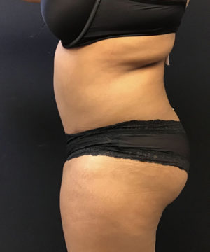 Liposuction