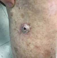 Squamous Cell Carcinoma