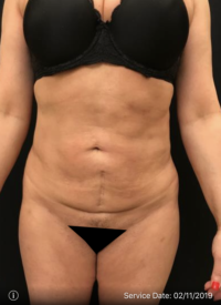 Tummy Tuck