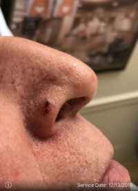 Basal Cell Carcinoma