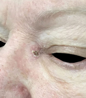 Basal Cell Carcinoma