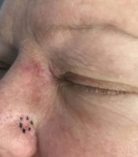 Basal Cell Carcinoma