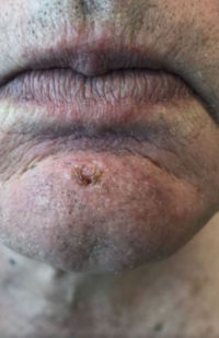 Basal Cell Carcinoma