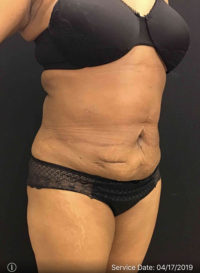 Liposuction