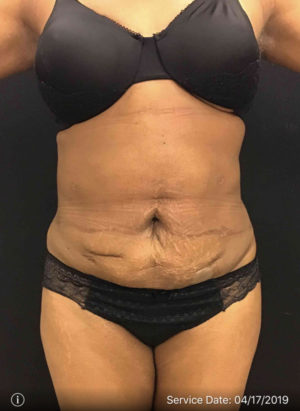 Liposuction