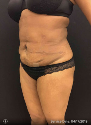 Liposuction