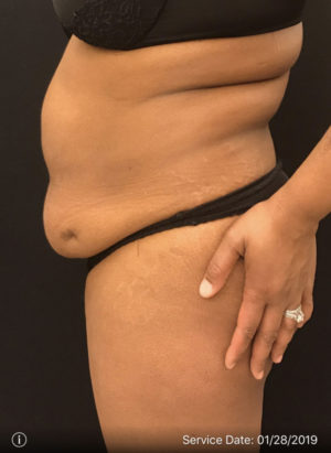 Liposuction