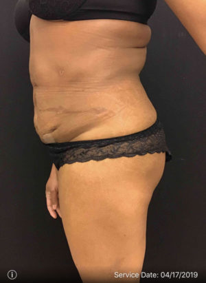 Liposuction