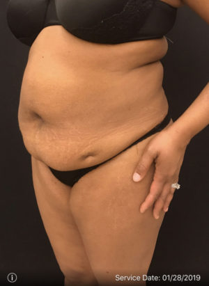 Liposuction