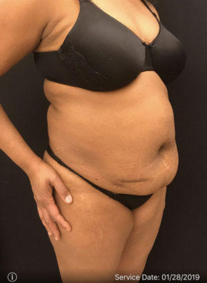 Liposuction