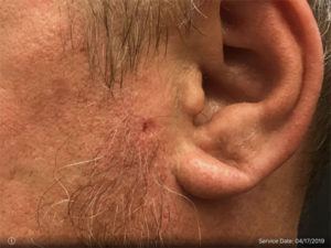 Basal Cell Carcinoma