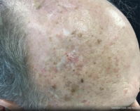 Basal Cell Carcinoma