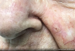 Basal Cell Carcinoma