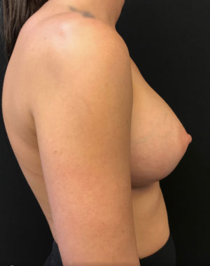 Breast Augmentation