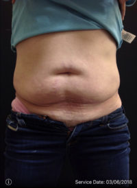 Coolsculpting