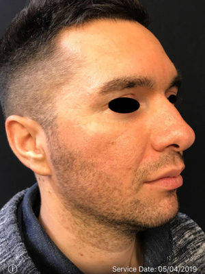Around the eyes