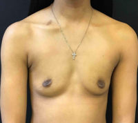 Breast Augmentation