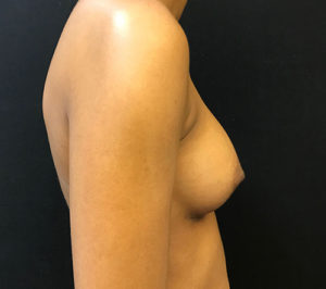 Breast Augmentation