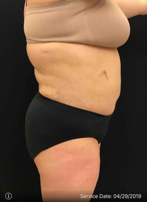 Liposuction