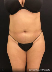 Liposuction