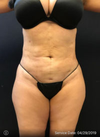 Liposuction