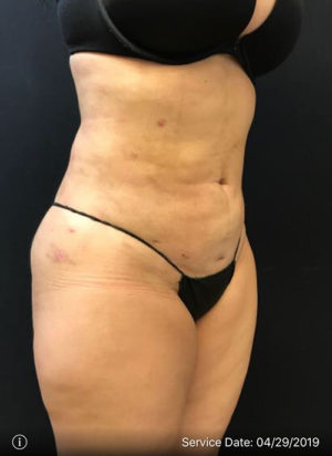 Liposuction