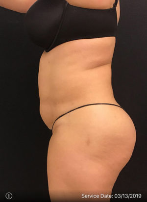 Liposuction