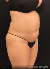 Liposuction