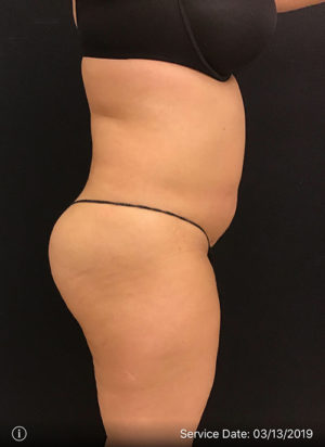 Liposuction