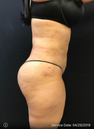 Liposuction