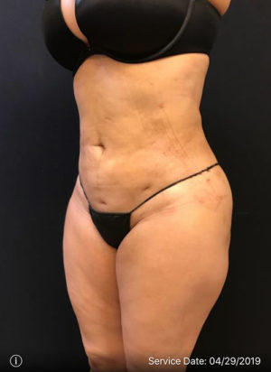 Liposuction