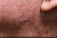 Basal Cell Carcinoma