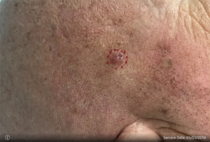 Basal Cell Carcinoma