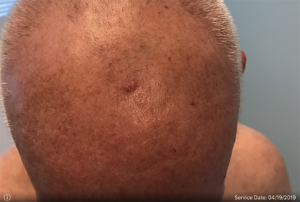 Basal Cell Carcinoma