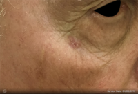 Basal Cell Carcinoma