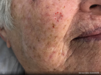 Basal Cell Carcinoma