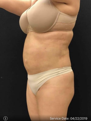 Liposuction