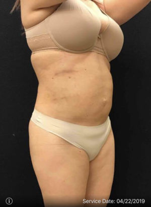 Liposuction