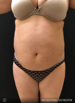 Liposuction