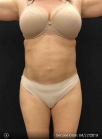 Liposuction