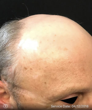 Neograft Hair transplantation