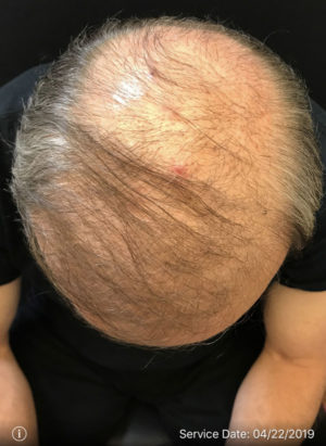 Neograft Hair transplantation