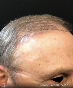 Neograft Hair transplantation