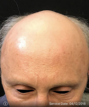 Neograft Hair transplantation